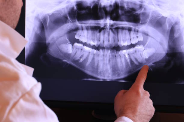 Best Emergency Wisdom Teeth Removal in Oak Grove, AL